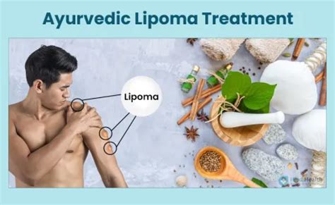 Best Ayurvedic Treatment for Lipoma - Medicines and Ointments