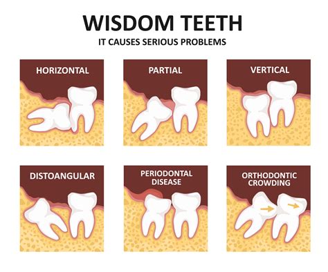Best Dental Insurance For Wisdom Teeth Removal Reddit