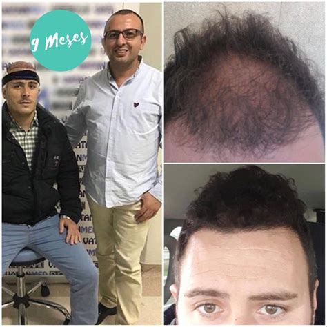 Best Hair Transplant Istanbul – A New Beauty Trend You’ll Want To Get In On