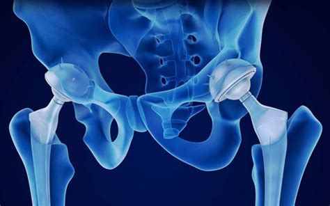 Best Hip Replacement Doctors in Fort Worth, TX Healthgrades