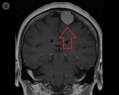 Best Meningiomas Doctors in Nashville, TN Healthgrades