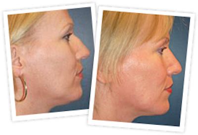 Best Rhinoplasty Vail Valley & Breckenridge - Mangat Plastic Surgery