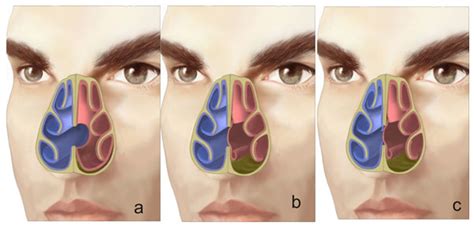 Best Septal Perforation Surgeon Septal Perforation Surgery