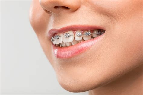 Extras policies that include cover for orthodontics 