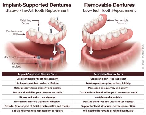 The dentist may also recommend crowns on your natural teeth as they improve the fit of your partial dentures. Full dentures are a total replacement for either the upper or lower teeth, or both. Any remaining teeth are removed and gum tissue is allowed to undergo preliminary healing before the dentures are placed in the mouth.. 