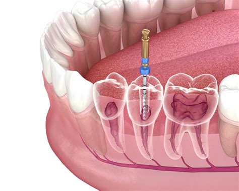 Best dental insurance for root canal. Things To Know About Best dental insurance for root canal. 