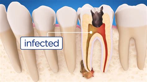 Best dental insurance plans for root canals. Things To Know About Best dental insurance plans for root canals. 