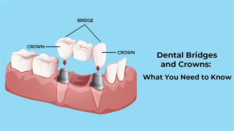 The cost of a dental crown varies, typically rang
