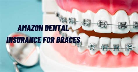 Dental insurance. Typically, basic dental insurance won't cover braces and orthodontic care, but more comprehensive plans do. The maximum discount is usually 50% and there's an annual or lifetime maximum. However, only certain types of braces will be covered. Read more about the best dental insurance plans.. 