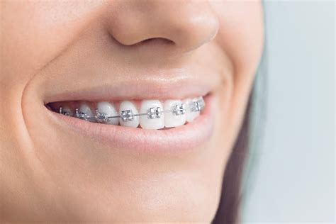 30 Sept 2023 ... With insurance. When orthodontics are included in your insurance plan, they can cover anywhere between 50-80% of treatment costs, with the rest ...