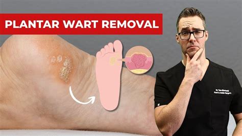 Best plantar wart removal at home. .  <a href=https://jun-ravil.xpager....