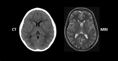 Beyin mr ve tomografi farkı