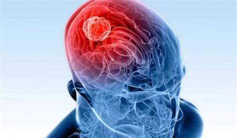Beyin tümörü blog