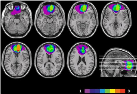 Bezopasne lezije na mozgu