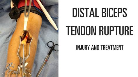 Bicep tendon repair cpt code. Several procedures have been developed to repair the tendon with minimal incisions. The goal of the surgery is to attach the torn tendon back to the shoulder. It is uncommon to … 
