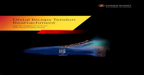 Biceps Tendon Reattachment - Zimmer Biomet