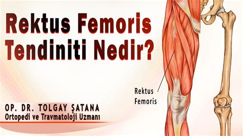 Biceps femoris kası ağrısı