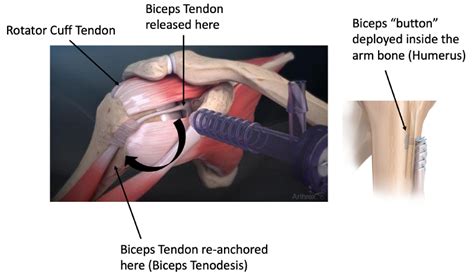 Biceps tenodesis failure symptoms.  One of the surgical procedures use...