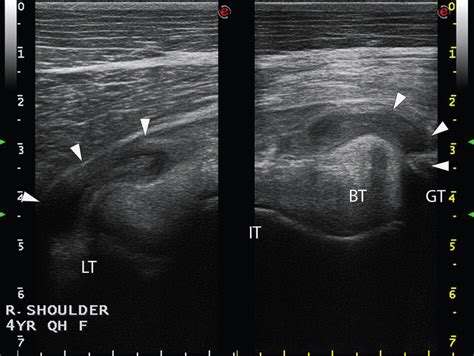 Bicipital Bursitis in Horses, Dogs and Cattle