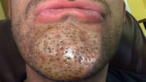 Big blackheads on chin. A cleft or dimpled chin is an inherited trait, as explained by John H. McDonald of the University of Delaware. The cleft indentation in each person varies in size and shape. Severa... 