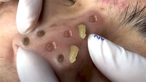 Watch on. A retired firefighter gets the Dr. Pimple Popper treatment in this ridiculously satisfying video of her extracting a sea of blackheads concentrated on his forehead. The patient was so .... 