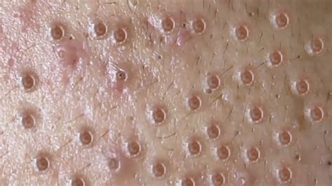 A new blackhead extraction video making the rounds on the internet has