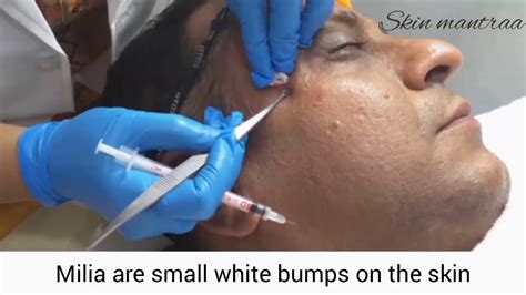 Big milia removal. how to skincarepopping big pimplescystic acne removal close updilated pore of winer pimple popper blackhead on facewhiteheads around noseblackhead whiteheads... 