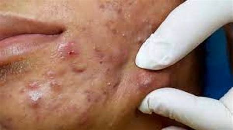 Extreme blackhead removal | Videos Popping large Pimples and Blackheads | Treatment of blackheads. 