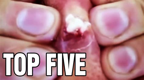 Big pimples being popped. By Sarah Felbin Published: Sep 07, 2021 2:05 PM EST. Save Article. Dr. Pimple Popper celebrated Labor Day weekend with seven different cyst videos on her … 