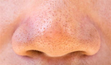 How to Remove Blackheads, Whiteheads, Comedones, Cysts and Pore Win