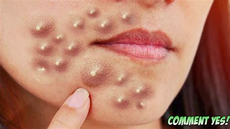 Big zits and pimples. What Is Cystic Acne? Cystic acne is when you have large, red, painful breakouts deep in your skin. Pimples start when a pore in your skin gets clogged, … 