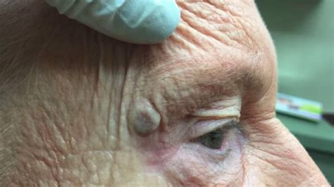 Biggest blackhead in the world. By Jennifer Nied Published: Jul 17, 2020. In Dr. Pimple Popper's latest Instagram video, she helps a patient with a giant blackhead in a mystery location. The blackhead has grown extra large and ... 