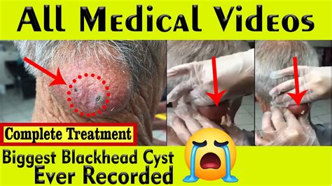 Posted in Cyst Popping • Tagged biggest cyst ever guinness world record, biggest cyst popped on back, biggest sebaceous cyst removal, dr pimple popper, massive+cyst+explosion, popping the biggest cyst on the planet, worst sebaceous cyst ever Post navigation. Huge Cyst In The Butt With Black Pus.. 