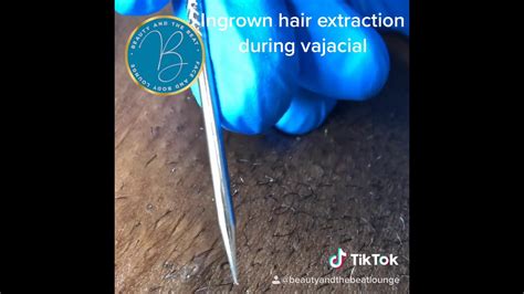 Ingrown hairs are hairs that curl and grow into t
