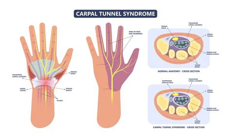 Bilateral Carpal Tunnel Syndrome Following COVID-19 ... - PubMed