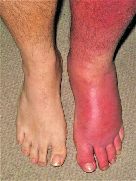 The most common site of infection is the lower extremities; however, any area of skin or soft tissue can be affected, but is rarely bilateral [12, 19, 25]. Orbital, buccal, and perianal cellulitis are variants of cellulitis differentiated by anatomic location.. 