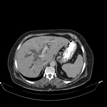 Bile duct dilatation Radiology Reference Article