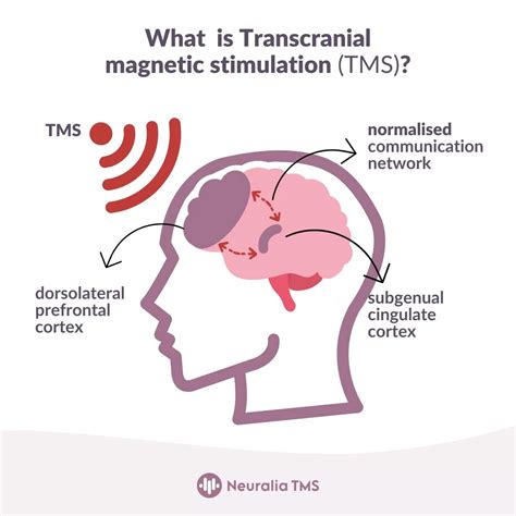 Billing Advice: Submitting Transcranial Magnetic Stimulation (TMS) Cla…