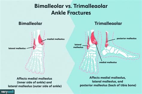 Bimalleolar fracture.  In the ankle, fractures can range from the less...