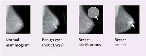 Biopsy for a Lump in the Breast: What You Need to Know