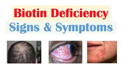 Biotin (Vit B7) Deficiency Signs & Symptoms (& Why They …