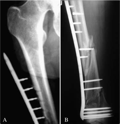 Biplanar fixation of a locking plate in the diaphysis improves ...