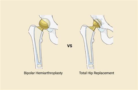 Bipolar hip hemiarthroplasty What is it and what to expect