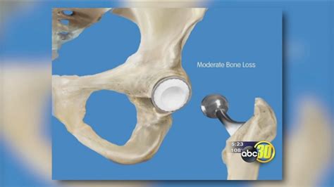 Birmingham Hip Resurfacing - California Pacific Orthopaedics