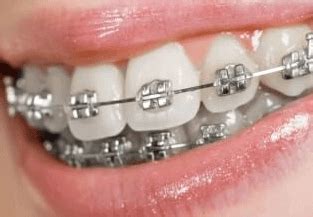 Birmingham braces. Sutton Orthodontic Centre is dedicated towards providing the very best in Birmingham Orthodontics treatment. Based in Sutton Coldfield. Call 0121 354 5596 
