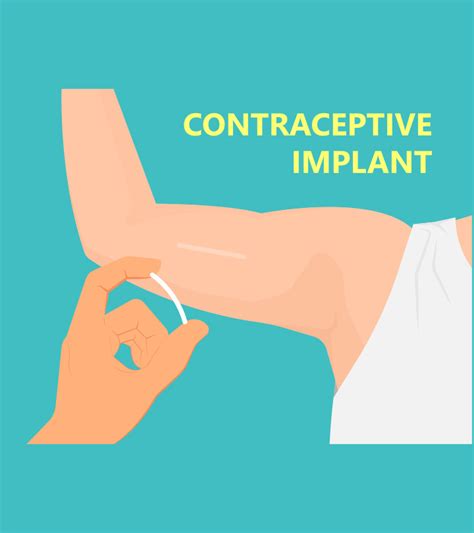 Birth Control Implants: Side Effects, Effectiveness, Cost, and ... - …