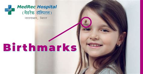 Birthmarks: Types, Causes, and Treatment