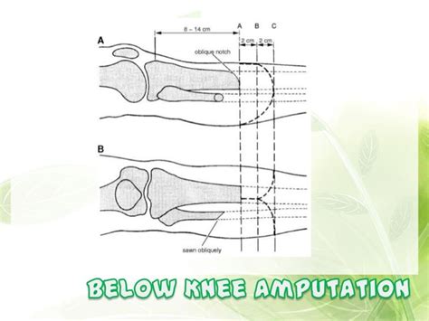 Bka cpt. Targeted reinnervation for the below-knee amputee has been performed on 22 patients at the authors' institution. Each patient has been followed on an outpatient basis for 1 year to evaluate symptoms of neuroma or phantom limb pain, patient satisfaction, and functionality. All subjects have denied neuroma pain following amputation. 