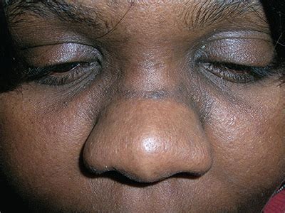 Black Line Across Nose: What Causes It? Can You …