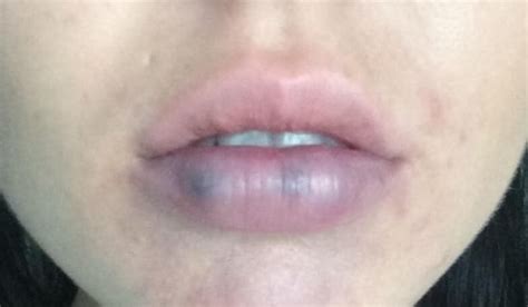 Black Spot on Lip, Inside, Pictures, Causes, Cancer, Std, Get Rid ...